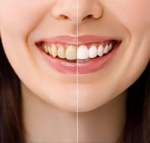 Teeth Whitening